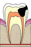 Cavities evolution 4 of 5 ArtLibre jnl.png