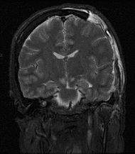 Brain herniation MRI.jpg