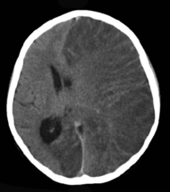 CT scan Rasmussen's encephalitis.png