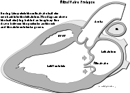 Heart mitral prolapse.svg