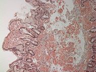 Small bowel duodenum with amyloid deposition congo red 10X.jpg