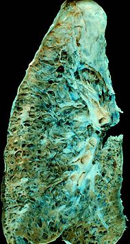 End-stage_interstitial_lung_disease_(honeycomb_lung).jpg